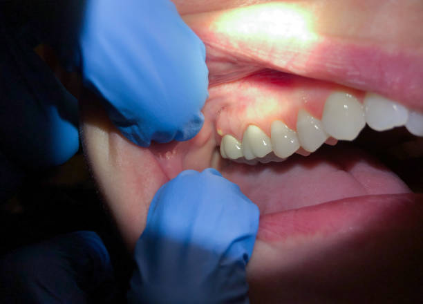 Best Emergency Tooth Extraction in Bernice, LA